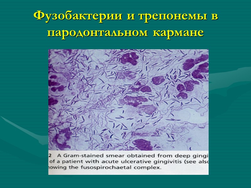 Фузобактерии и трепонемы в пародонтальном кармане